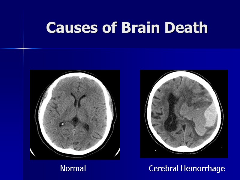 Causes of Brain Death Normal Cerebral Hemorrhage